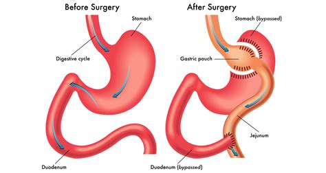 us alternatives to gastric sleeve surgery